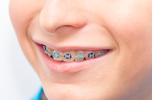 get braces in winter lawrenceville orthodontics
