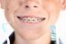 get braces before summer lawrenceville orthodontists