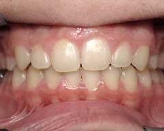 Gia’s front teeth protruded beyond her lower lip. Her orthodontic treatment time was 18 months and treatment was with conventional braces.