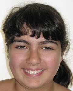 Gia’s front teeth protruded beyond her lower lip. Her orthodontic treatment time was 18 months and treatment was with conventional braces.