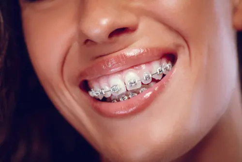 Braces Wearers Can Still Have a Happy Halloween - great smile with braces
