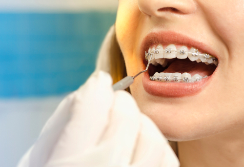 dental braces